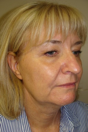 Facelift Before and After 26 | Sanjay Grover MD FACS