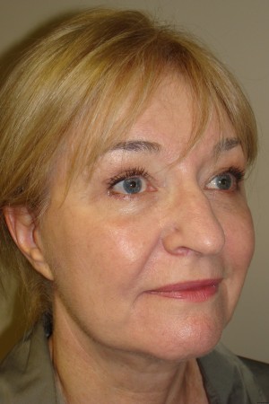 Facelift Before and After | Grover Aesthetics