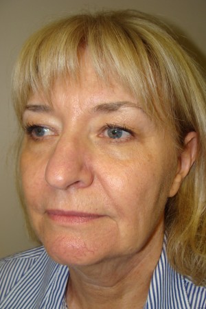 Facelift Before and After 34 | Grover Aesthetics