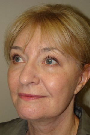 Facelift Before and After 34 | Grover Aesthetics