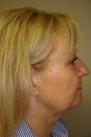Facelift Before and After 34 | Grover Aesthetics