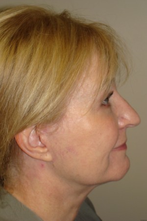 Facelift Before and After 34 | Grover Aesthetics