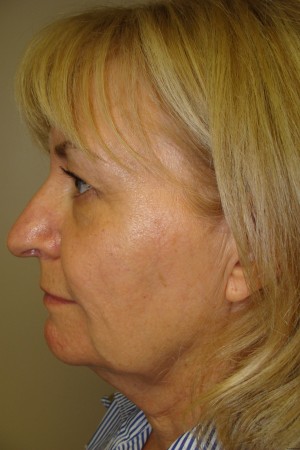Facelift Before and After 34 | Grover Aesthetics