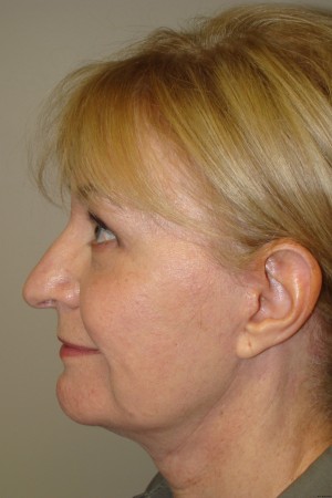 Facelift Before and After 34 | Grover Aesthetics