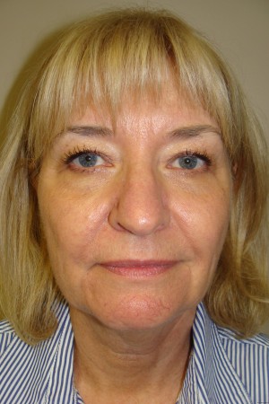 Facelift Before and After 34 | Grover Aesthetics