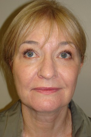 Facelift Before and After 34 | Grover Aesthetics