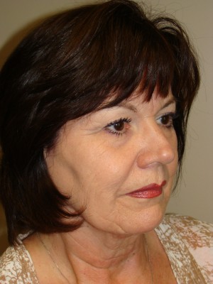 Facelift Before and After | Grover Aesthetics