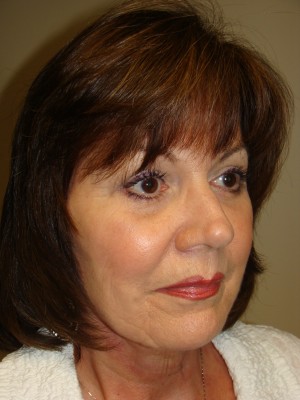 Facelift Before and After | Grover Aesthetics