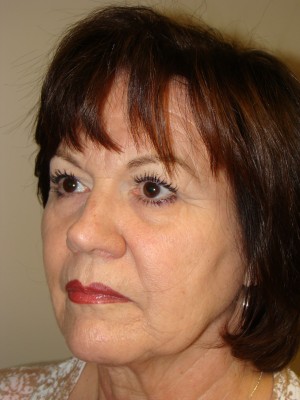 Facelift Before and After 35 | Grover Aesthetics