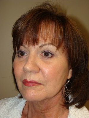 Facelift Before and After 35 | Grover Aesthetics