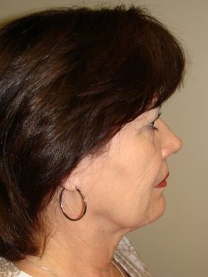 Facelift Before and After 35 | Grover Aesthetics