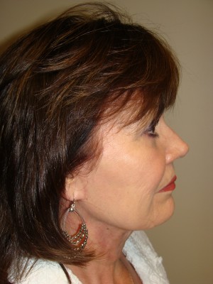 Facelift Before and After 35 | Grover Aesthetics