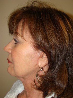 Facelift Before and After 35 | Grover Aesthetics