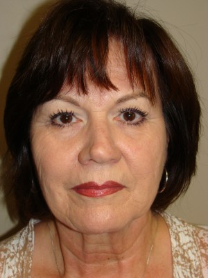 Facelift Before and After 35 | Grover Aesthetics