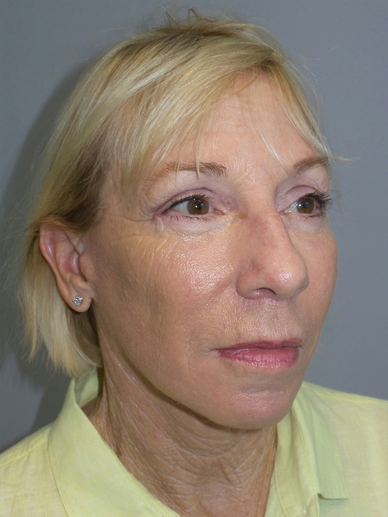 Facelift Before and After 36 | Sanjay Grover MD FACS