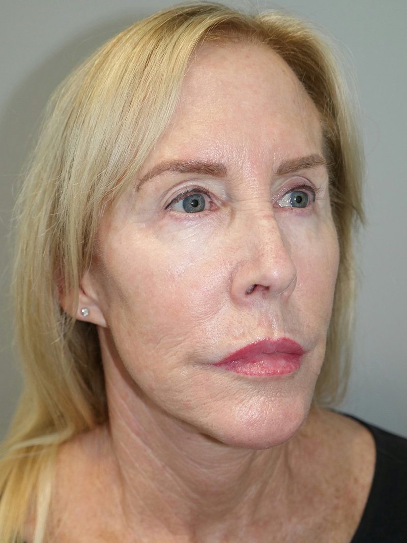 Facelift Before and After 37 | Sanjay Grover MD FACS