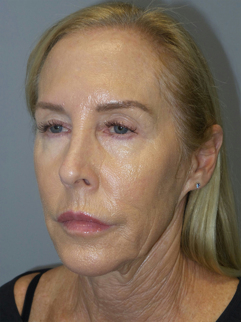 Facelift Before and After 37 | Grover Aesthetics