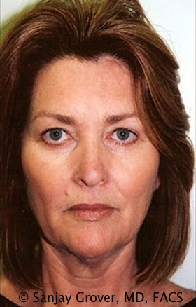 Facelift Before and After 07 | Sanjay Grover MD FACS