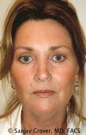 Facelift Before and After | Sanjay Grover MD FACS