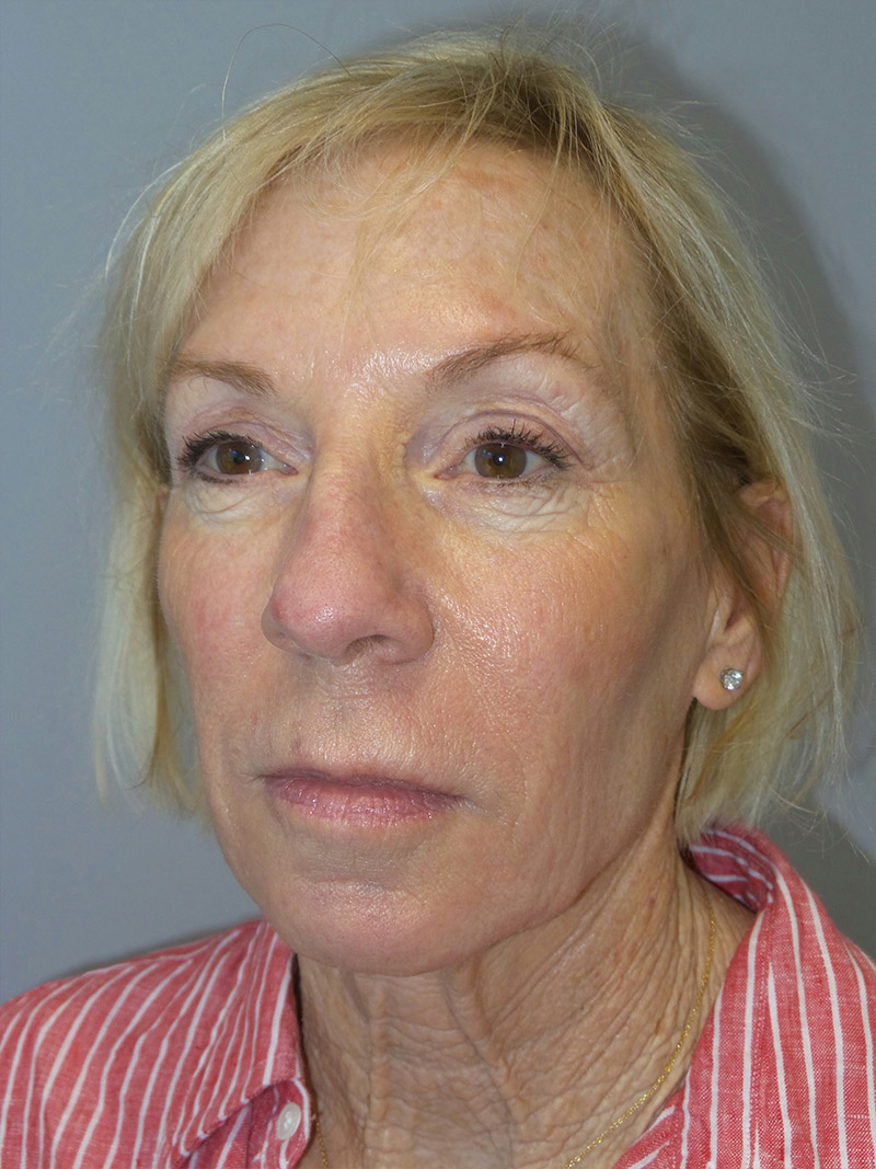 Facelift Before and After 38 | Grover Aesthetics