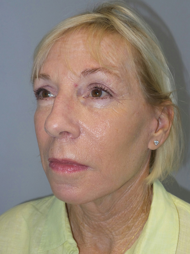 Facelift Before and After 38 | Grover Aesthetics