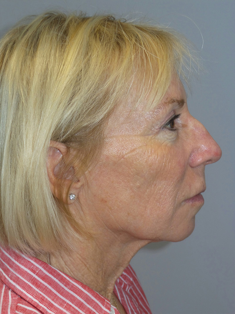 Facelift Before and After 38 | Grover Aesthetics