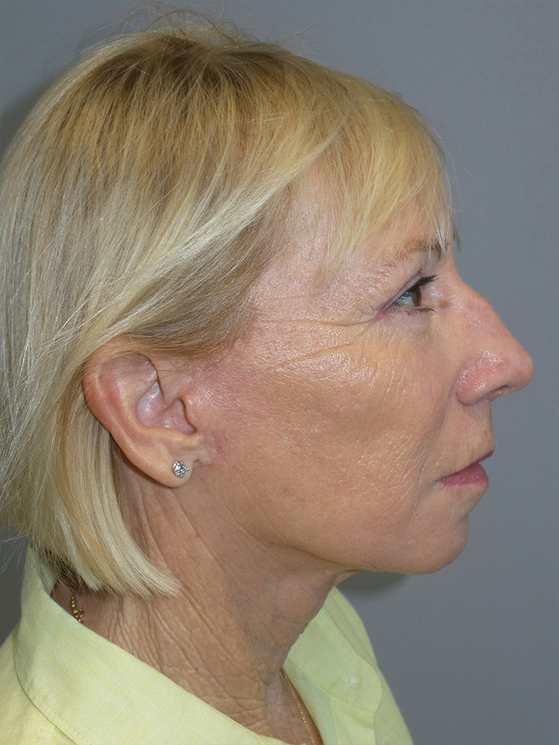 Facelift Before and After 38 | Grover Aesthetics