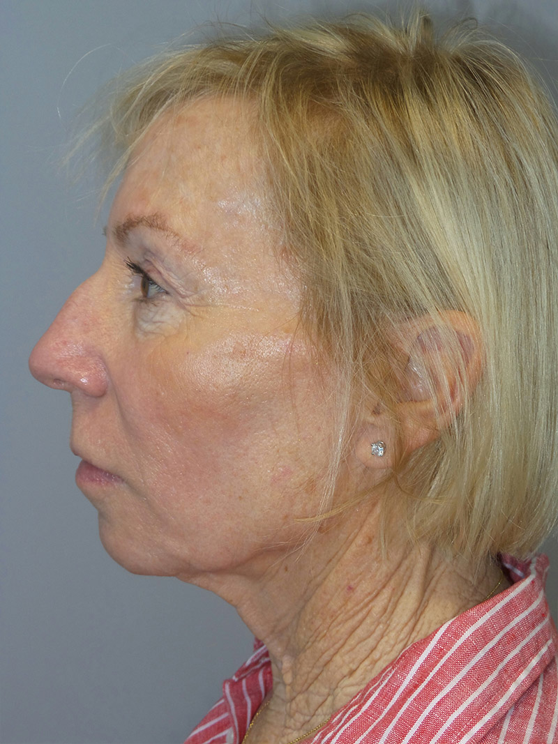 Facelift Before and After 38 | Grover Aesthetics