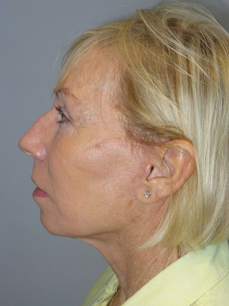 Facelift Before and After 38 | Grover Aesthetics