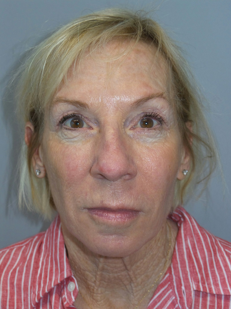 Facelift Before and After 38 | Grover Aesthetics