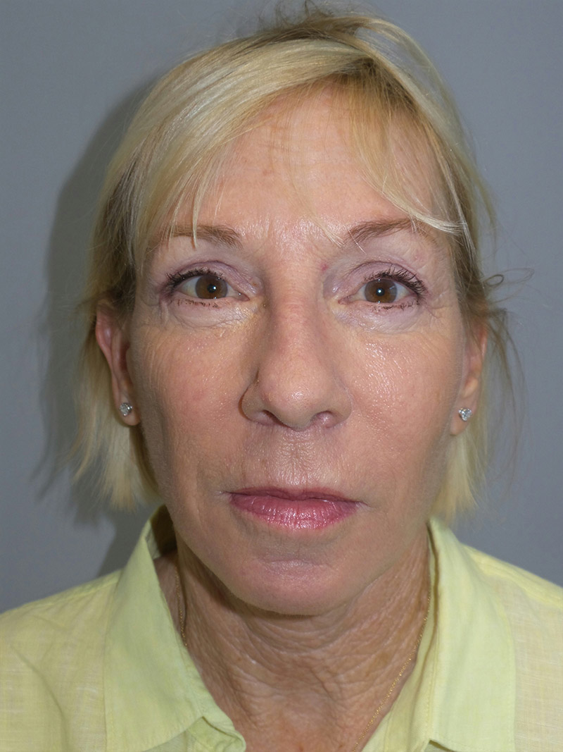 Facelift Before and After 38 | Grover Aesthetics