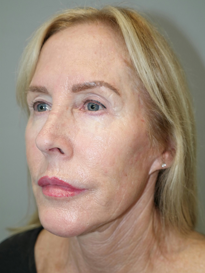 Facelift Before and After 39 | Grover Aesthetics