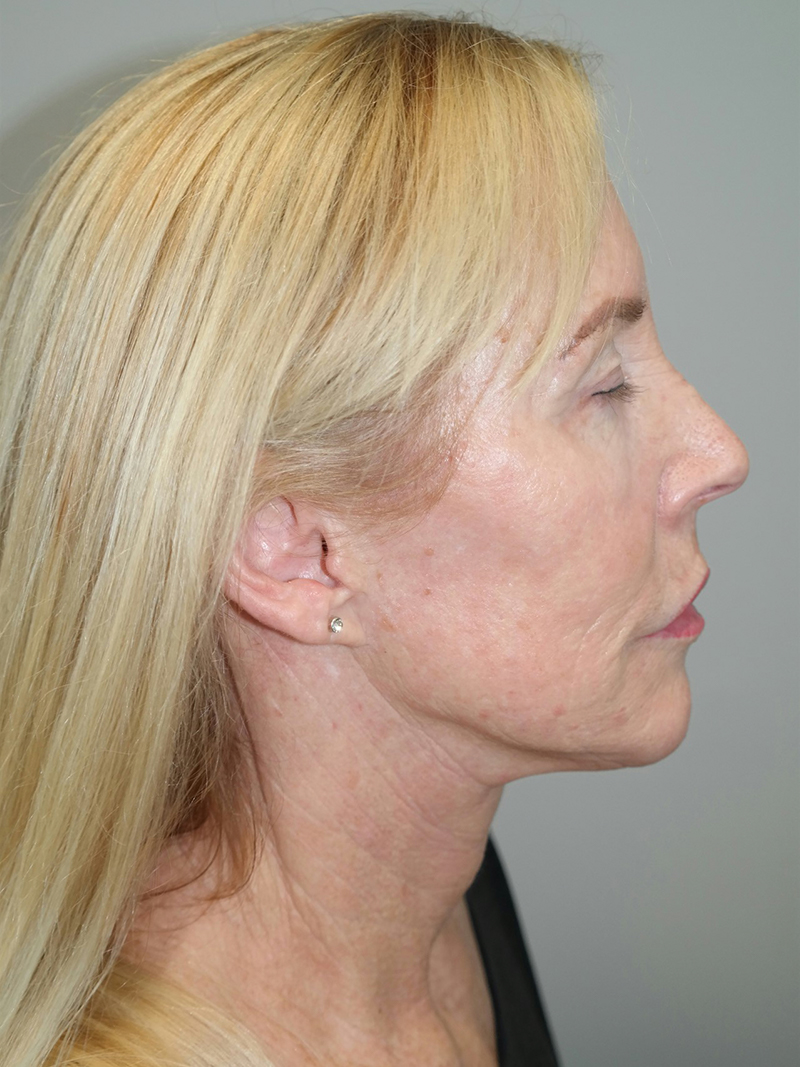 Facelift Before and After 39 | Grover Aesthetics