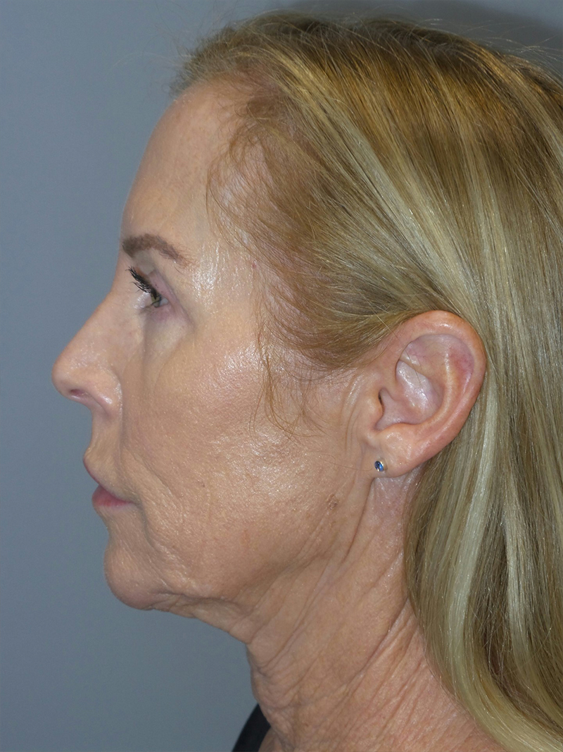 Facelift Before and After 39 | Grover Aesthetics