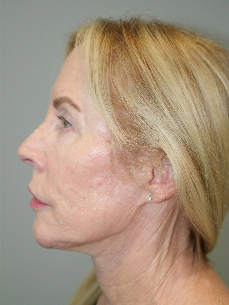 Facelift Before and After 39 | Grover Aesthetics