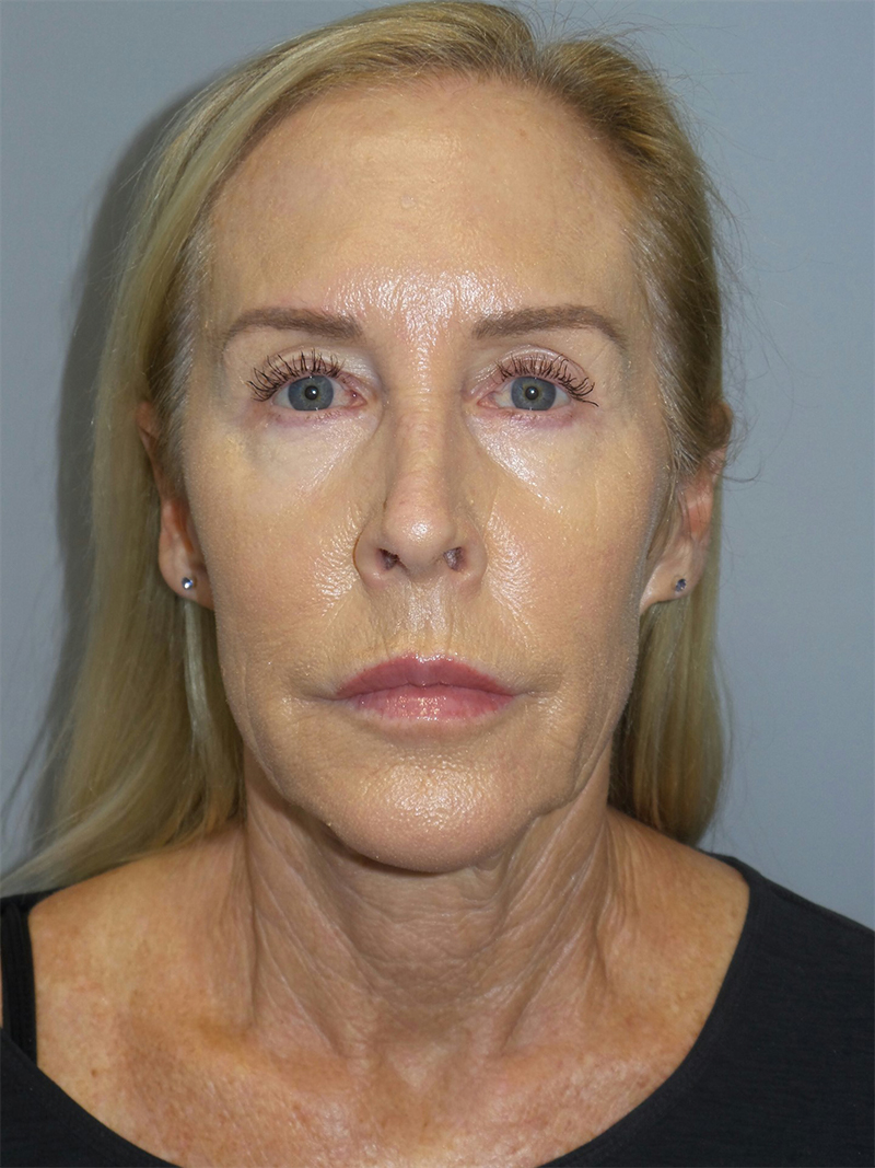 Facelift Before and After 39 | Grover Aesthetics