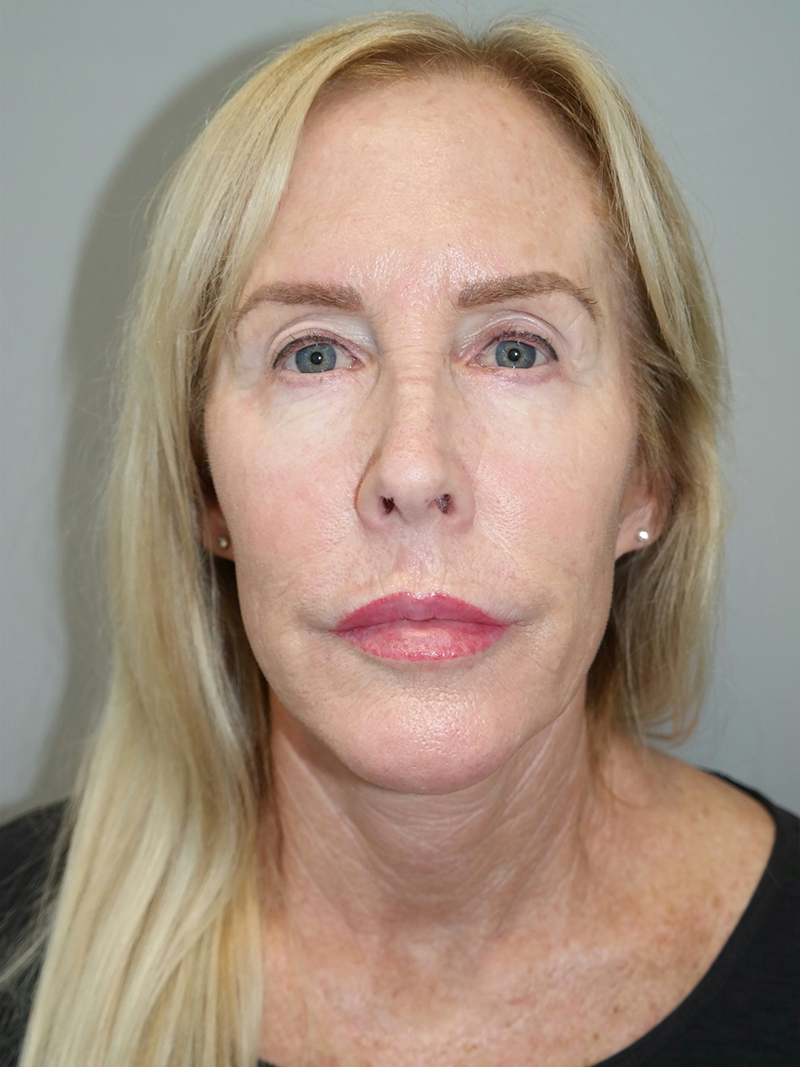 Facelift Before and After 39 | Grover Aesthetics