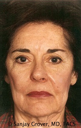 Facelift Before and After | Grover Aesthetics