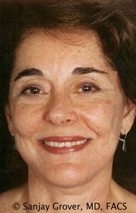 Facelift Before and After | Grover Aesthetics