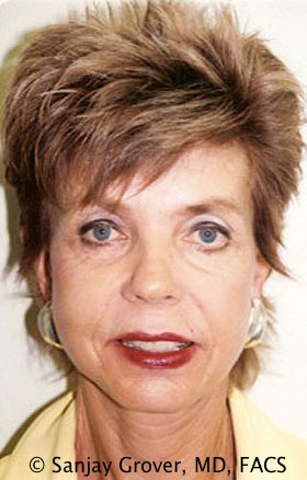 Facelift Before and After | Grover Aesthetics