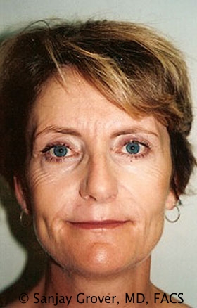 Facelift Before and After | Grover Aesthetics
