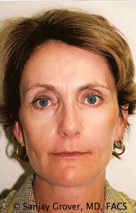 Facelift Before and After | Grover Aesthetics