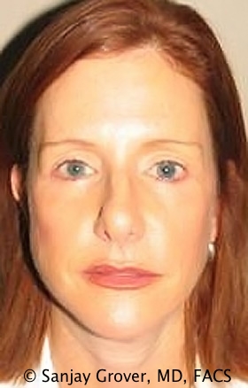 Facelift Before and After | Grover Aesthetics
