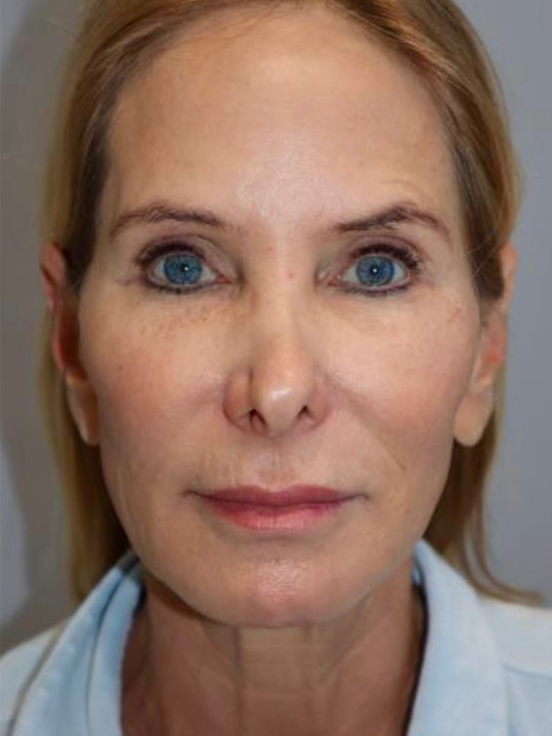 Facelift Before and After | Grover Aesthetics