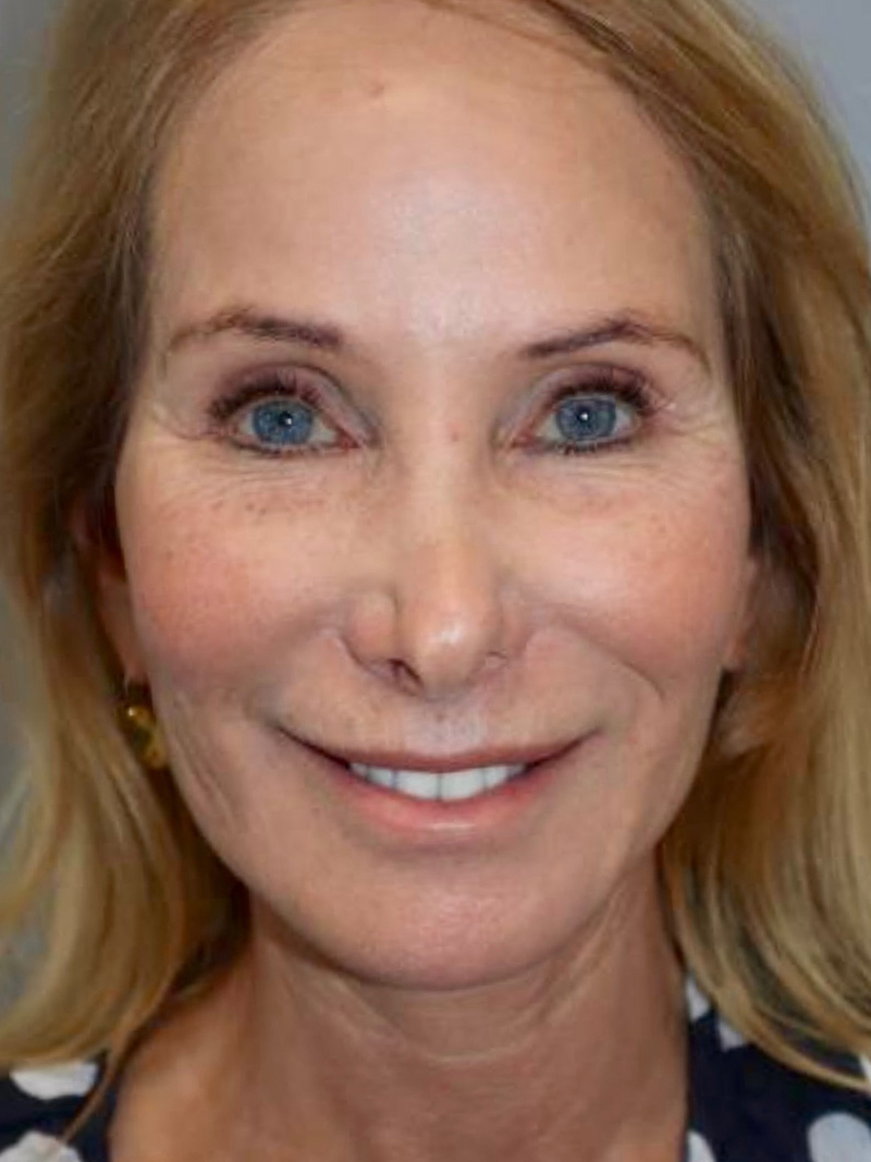 Facelift Before and After | Grover Aesthetics