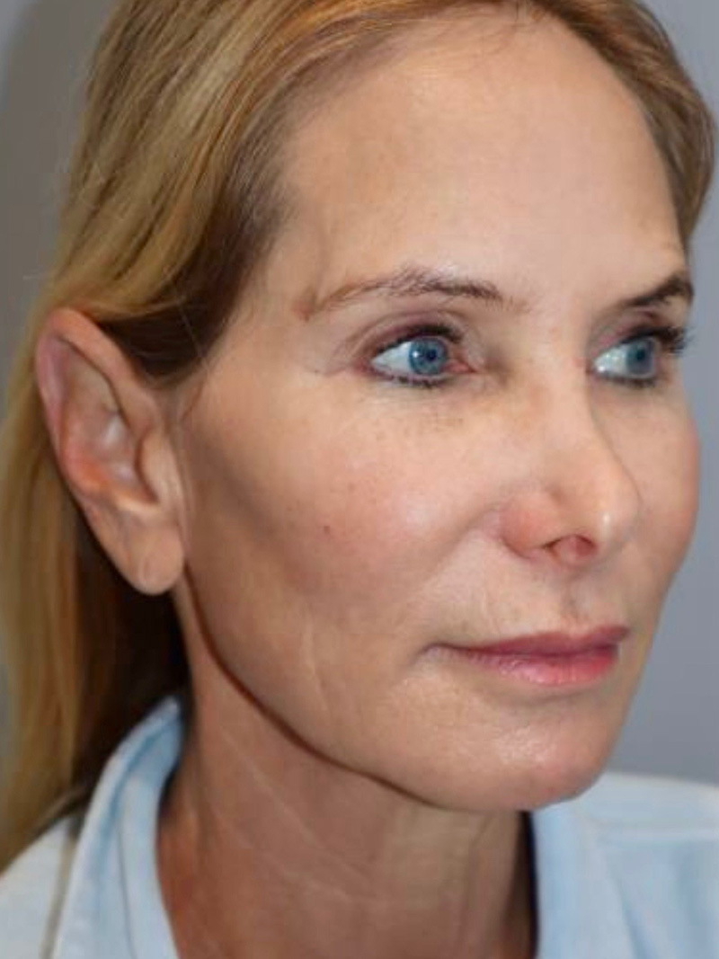 Facelift Before and After 47 | Grover Aesthetics