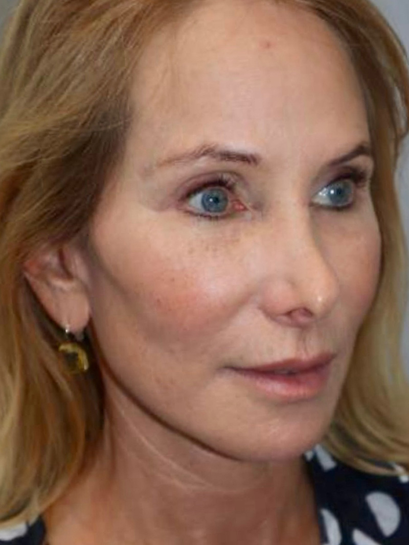 Facelift Before and After 47 | Grover Aesthetics