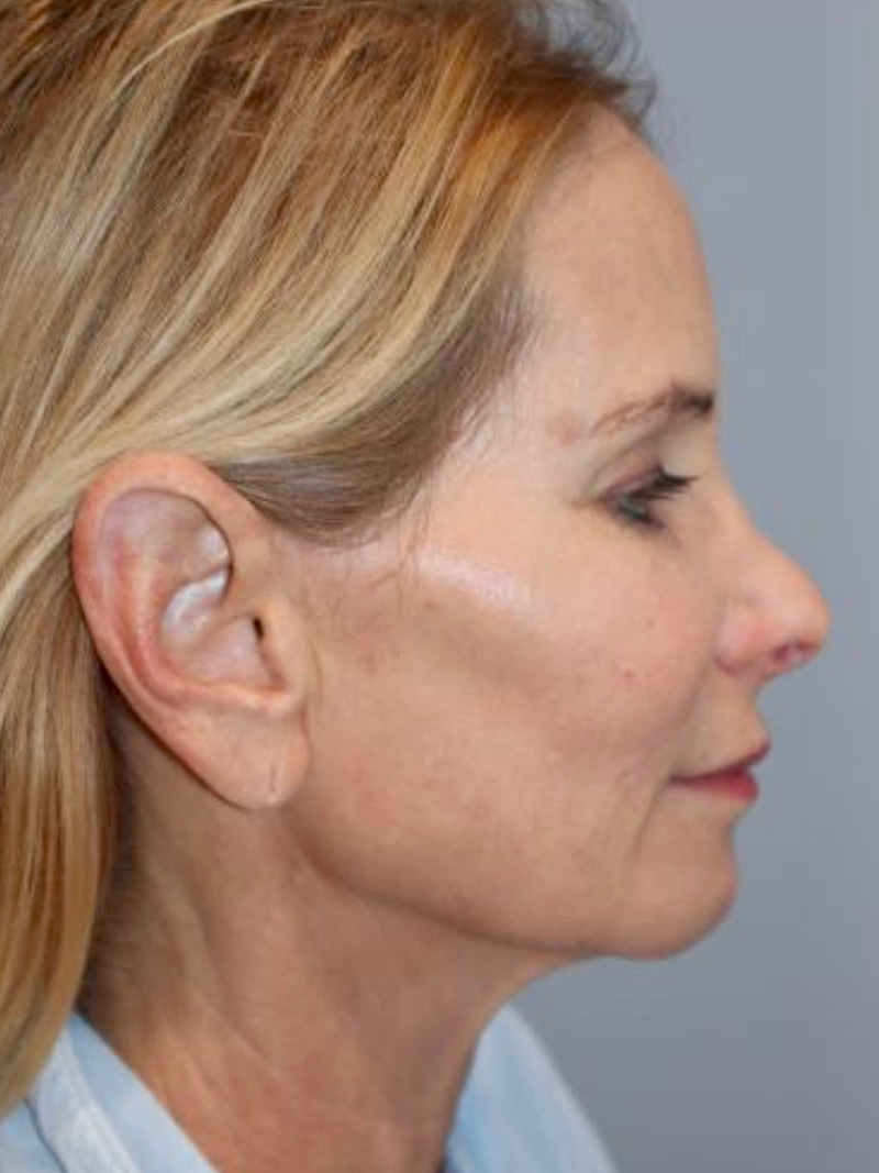 Facelift Before and After 47 | Grover Aesthetics