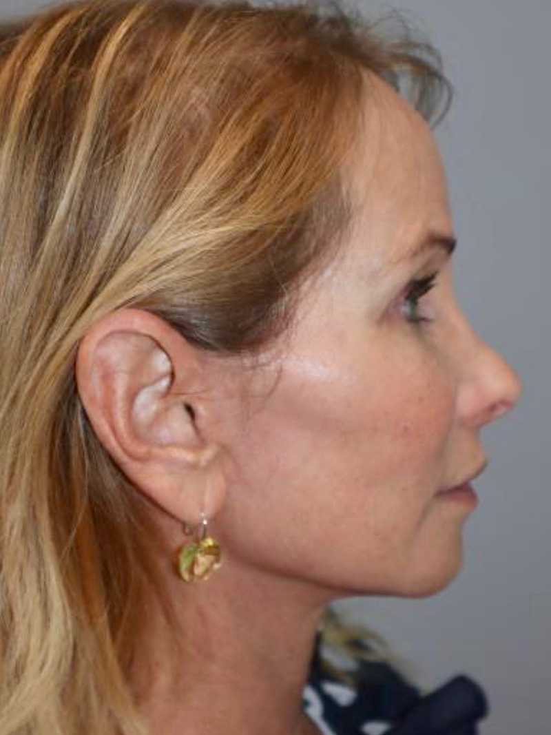 Facelift Before and After 47 | Grover Aesthetics