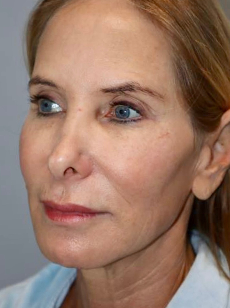 Facelift Before and After 47 | Grover Aesthetics